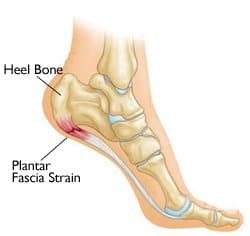 A diagram showing pain in the heel and arch
