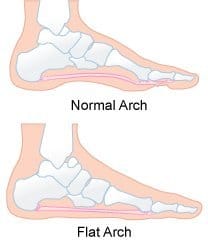 The difference between normal arches and fallen arches