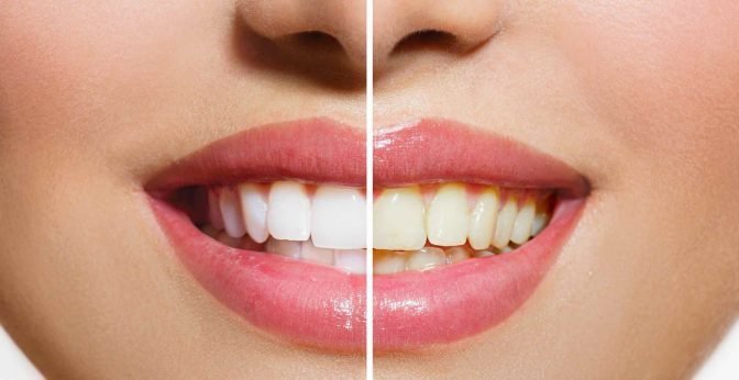 Most Effective Teeth Whitening e