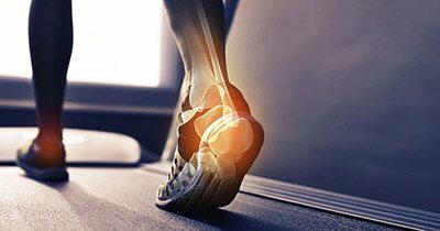 Plantar Fasciitis