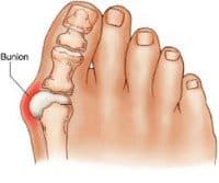 A bunion on someones right foot