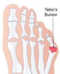 A Tailors Bunion (Also known as a bunionette)