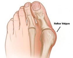 A Hallux Valgus on someones left foot (chronic bunion)