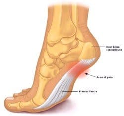 A diagram showing the causes of arch pain