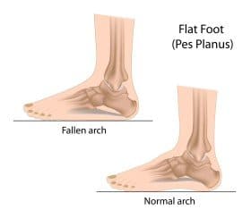 Flat feet and normal feet compared