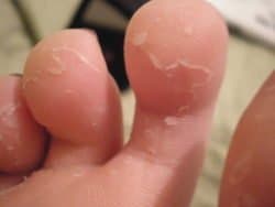 Peeling skin from underneath toes