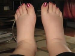 A woman with swollen feet