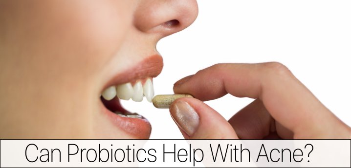 Probiotics for Acne