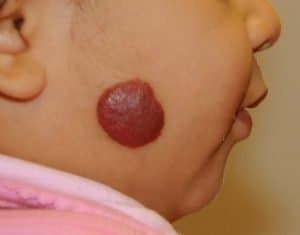 Newborn-Baby-Face-Rash-Hemangioma
