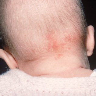 Stork-Bites-baby-skin-disorder, review, analysis