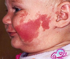natural birthmarks on babies