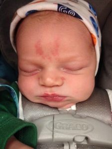 cute baby sleeping with birthmark on forehead